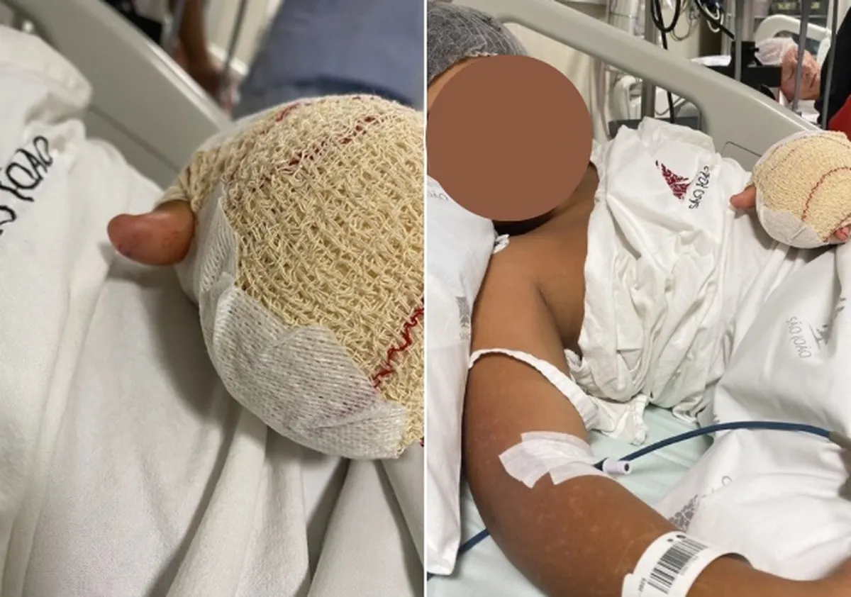 Menino brasileiro perde dois dedos após suposta agressão em escola portuguesa - Imagem do artigo